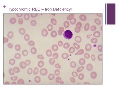 Hypochromic cells – most common cause is iron deficiency

Populations most at risk are women in their reproductive years and children


Caption:

The most common cause for a hypochromic microcytic anemia is iron deficiency. The most common n...