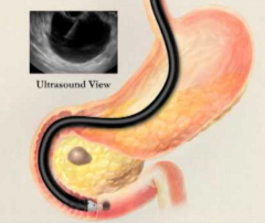 Endoscopic ultrasonography (EUS)