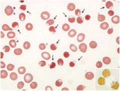 Bite cells, Blister Cells, Heinz Bodies, polychromasia