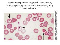 HJB, target cells, acanthrocytes