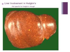 If liver is involved it puts the cancer at a higher stage


Caption:

This is a liver that is involved with Hodgkin's disease. The staging of Hodgkin's disease is very important in determining therapy. Thus, it is important to determine whether...