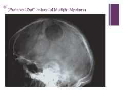 No this is not histology.

Lucent areas in the X-ray are the lesions

Enhanced osteoclastic activity in multiple myeloma

 -Protein produced (MIP-1alpha) that activates receptor of a ligand that stimulates osteoclastic activity

Bone pain is ...