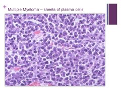 Progressive disease


Caption:

In this bone marrow biopsy section at medium power, there are sheets of plasma cells of multiple myeloma that are very similar to normal plasma cells, but the cells may also be poorly differentiated. Usually, the...