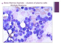 Caption:

Here is a smear of bone marrow aspirate from a patient with multiple myeloma. Note that there are numerous well-differentiated plasma cells with eccentric nuclei and a perinuclear halo of clearer cytoplasm. There is also an abnormal pla...