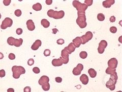 Rouleax, elongated cells, hypochromic cells