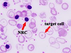 nRBCs, HJBs, Target cells, microcytes, hypochromasia