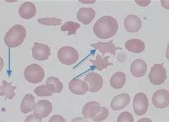 Irregular, spiculated red cells with few unevenly distributed surface projections of various length and diameter