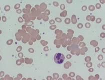 An antibody coats the erythrocyte causing bridging and clumping