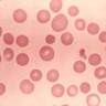 A variation in the size of RBC, may be due to the presence of macrocytes, microcytes or both