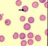 Basophilic nuclear remnants seen in young erythrocytes in response to anemia; removed by spleen