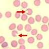 Spiculated red cells with two or more pointed projections