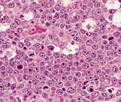 Pathologic diagnosis of cervical lymph node biopsy:
• Sections show: sheets of tumor cells characterized by lymphocytes with large cell size, round to irregular nuclear contours, vesicular chromatin, multiple distinct eosinophilic nucleoli, and...