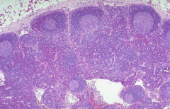 Benign, "reactive" lymph node - they may develop a malignancy in many years