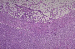 What do you notice about this lymph node?