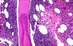 Bone marrow involved by lymphoma