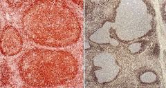 - Stained with bcl-2
- Left: Follicular Lymphoma (strong immunostaining for bcl-2)
- Right: Reactive Lymphadenopathy (negative for bcl-2)