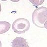 Thin erythrocytes with increased membrane or decreased volume