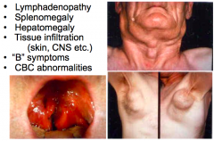 Case 2:
- Patient presents with lymphadenopathy, splenomegaly, hepatomegaly, tissue infiltration (skin, CNS, etc), "B" symptoms (fevers, night sweats, weight loss), and CBC abnormalities

What should you do to work up this patient?