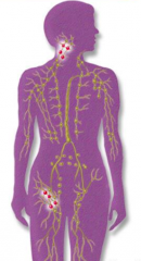 Two or more lymph node regions in different parts of the body