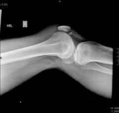 A 36-year-old female sustains a knee injury after falling from a ladder onto her flexed knee. A radiograph is shown in Figure A. Which of the following treatment options has been shown to have the best outcomes with this injury?  
1.  Long leg ca...