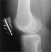 The clinical presentation is consistent with and inferior pole patella fracture. Open reduction and internal fixation is the most appropriate treatment of this injury pattern. 

Whenever possible, salvage of the inferior pole through open reduct...