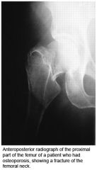 In the treatment of acute osteoporotic compression fractures, vertebroplasty has been shown to have which of the following benefits in randomized, double-blind, placebo-controlled trials compared to nonoperative treatment. 
1.  Improvement in pai...