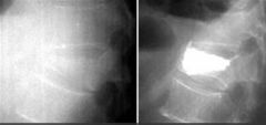 Randomized, double-blind, placebo-controlled trials have shown no beneficial effect of vertebroplasty as compared with a sham procedure in patients with painful osteoporotic vertebral fractures.

Vertebral compression fractures (VCF) are the mos...