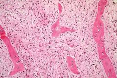 Patients with Paget's disease are predisposed to secondary osteosarcoma, chondrosarcoma, and spindle cell sarcoma of bone (e.g. fibrosarcoma) all which can occur through Pagetoid lesions. Ans4