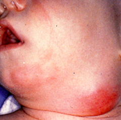 Acute Cervical Lymphadenitis