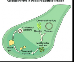 Gallstone formation