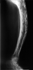 A 65-year-old man complains of deformity of the right leg. He denies pain at rest but does complain of ankle and lower leg pain when walking more than a half mile. A radiograph is shown in Figure A. Following 6 months of orthotic and brace treatme...