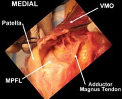 The femoral attachment of the medial patellofemoral ligament (MPFL) is located between the femoral medial epicondyle and the adductor tubercle. During lateral patellar dislocation, the femoral attachment of the MPFL is a common site of injury and ...