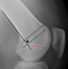 Correct positioning of a graft for MPFL reconstruction requires accurate placement of the femoral attachment site which is anterior to a line extended from the posterior cortex and just proximal to the posterior extension of Blumensaat's line. Int...