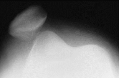 A 27-year-old football player sustains an acute lateral patellar dislocation. Which of the following is the most likely site of injury seen on MRI?  
1.  Soft-tissue patellar-sided avulsion of medial patellofemoral ligament
2.  Soft-tissue femor...