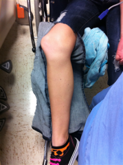 The most common site of medial patellofemoral ligament (MPFL) injury is a soft-tissue avulsion injury of the ligament off the femur. Both midsubtance and patellar-sided soft tissue avulsions are more common than bony avulsions. Bony avulsion off t...