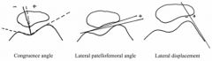 The lateral patello-femoral angle is the angle formed by lateral patellar facet and a line drawn across most prominent aspects of anterior portion of the trochlea on a CT scan or Sunrise view radiograph. If there is a negative patellar tilt on thi...
