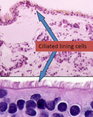 Columnar to cuboidal cells with cilia and occasionally mucin

Mass effect type lesion