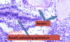 Adamantinomatous-->Cystes filled with dark brown fluid (motor oil) and cholesterol crystals; PALISADING SQUAMOUS EPITHELIUM; ABUNDANT KERATIN

Papillary type-No Keratin formation