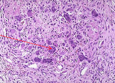 Calcium; related to bone disease-->osteitis fibrosia cystica; erosion of bone matrix by osteoclasts

Brown tumor-->reactive giant cells, hemorrhage (picture)
