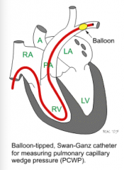 Pass a catheter with pressure monitor through SVC, right atrium, right ventricle, and pulmonary artery until it is wedged into the smallest artery it will fit into --> inflate balloon and measure pressure 

Swan-Ganz catheterization