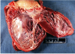 If the patient died and came to autopsy, his heart would likely have this gross pathology. Can you describe and diagnose it?
�