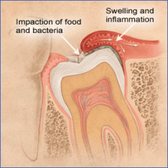 Pericoronitis 

inflammation of the soft tissues surrounding the crown of a partially erupted tooth (often Wisdom teeth)Signs and Symptoms inflamed soft tissue (operculum) which begins at the crown and extends into surrounding gingival tissue ...