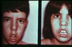 What kind of facial appearance does someone with Myotonic dystrophy have?