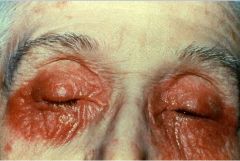 What does contact dermatitis look like?  What occurs to the conjunctiva?