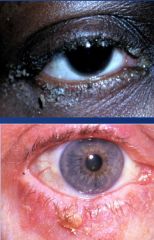 What is the clinical presentation of chronic blepharitis?