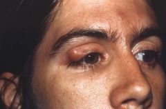 What is the clinical presentation of a stye?