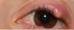 What would cause a stye to have to be removed?