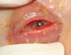 What is a serious complication of N. gonorrhoeae bacterial conjunctivitis?