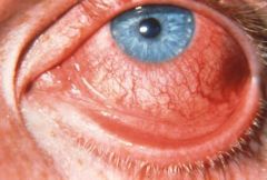 What's the clinical presentation of viral conjunctivitis