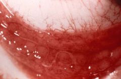 What is the clinical presentation of conjunctivitis chlamydia?